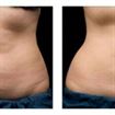 Cool Sculpting - o metoda controversata de slabire face senzatie printre oamenii din lumea intreaga "Cool Sculpting" - o metoda controversata de slabire face senzatie printre oamenii din lumea intreaga