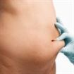 O braileanca de 37 de ani in stare grava dupa o operatie de liposuctie