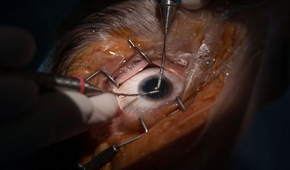 Glaucomul, boala care afectează cel mai des regiunea noastră